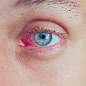 red eye